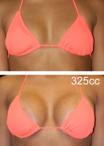 Before and After Breast Augmentation in Chicago