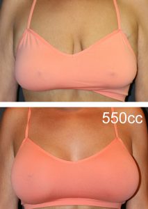 before and after photo of a patient receiving 550cc breast implants